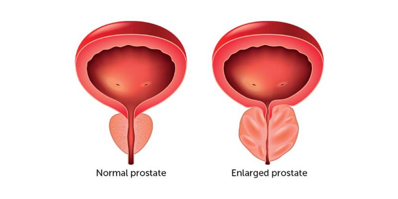 Prostate Enlargement Treatment in Charni Road