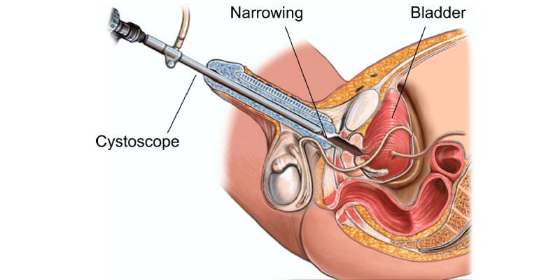 Stricture Urethra Treatment South Mumbai